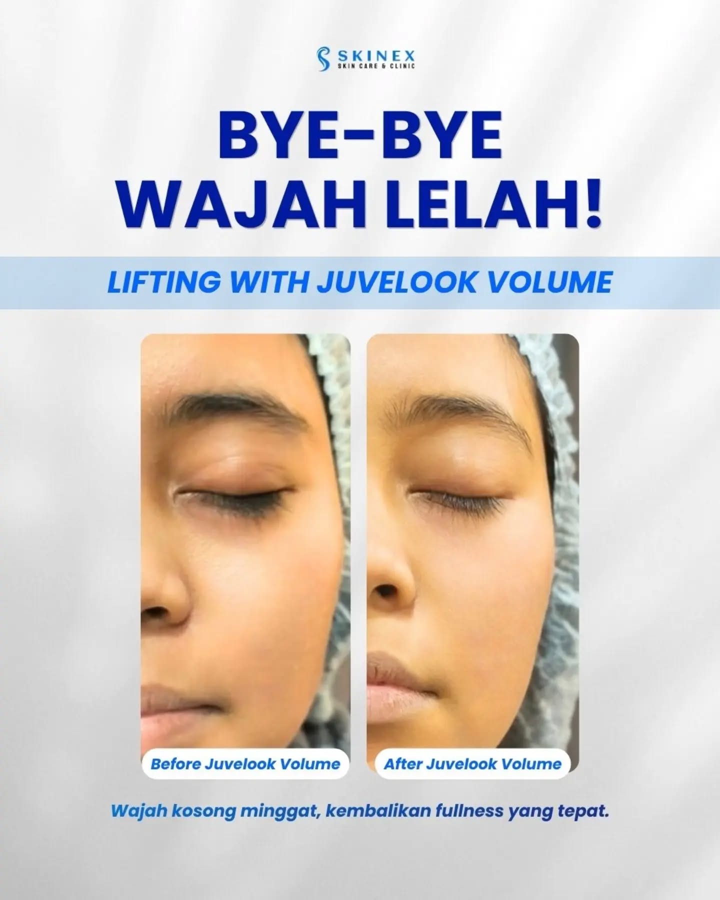 Bye-bye wajah lelah & kendur, hello volume + lifting effect!  ​Mulai masuk usia 40-an, sadar gak sih kalau… (@skinexbintaro di Instagram)